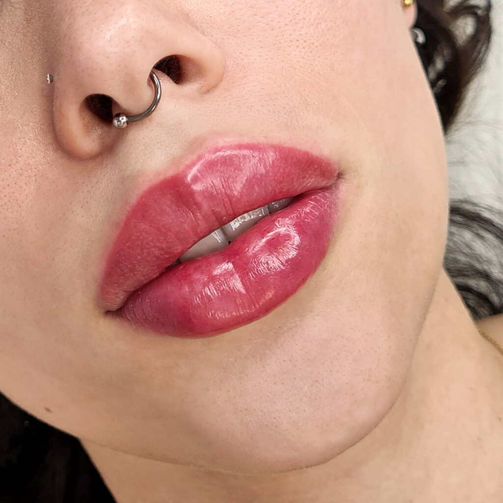 lip filling